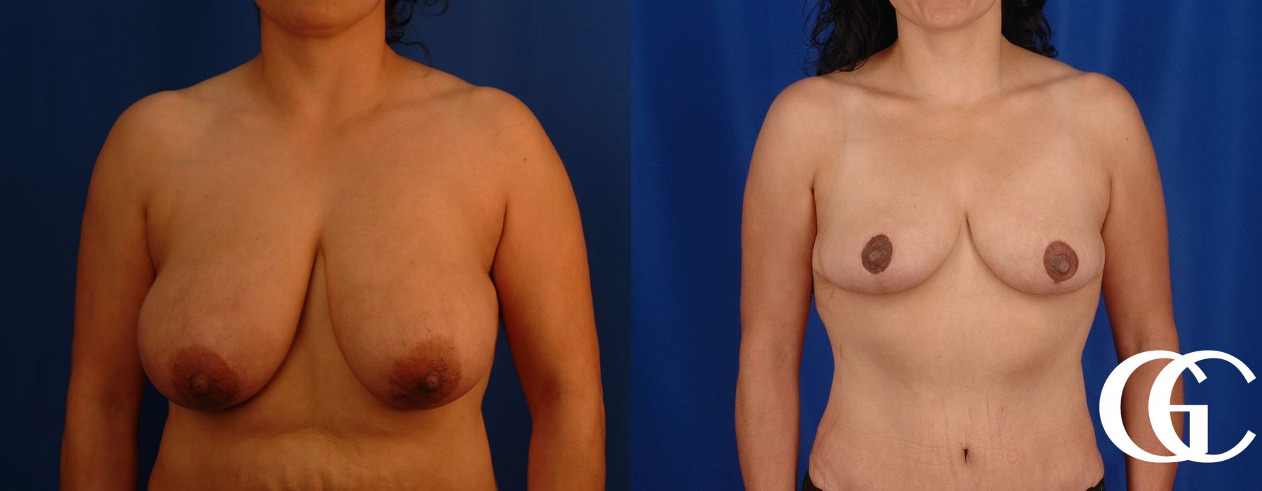 Breast Reduction - Case 7310
