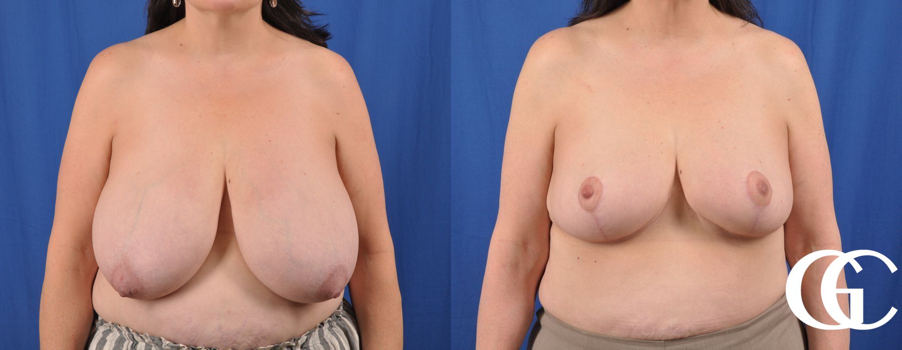 Breast Reduction - Thumbnail 2