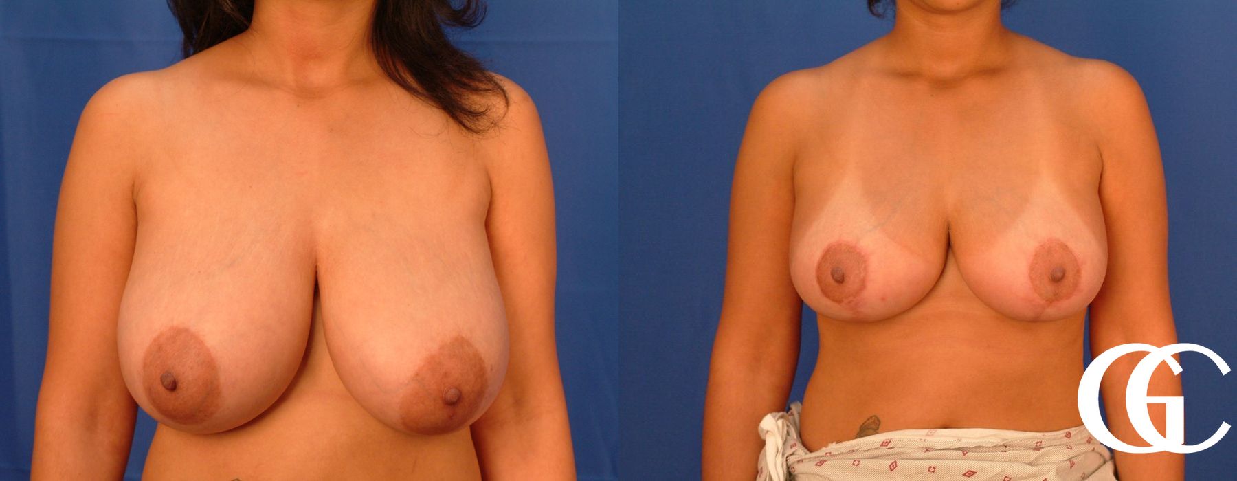 Breast Reduction - Thumbnail 2