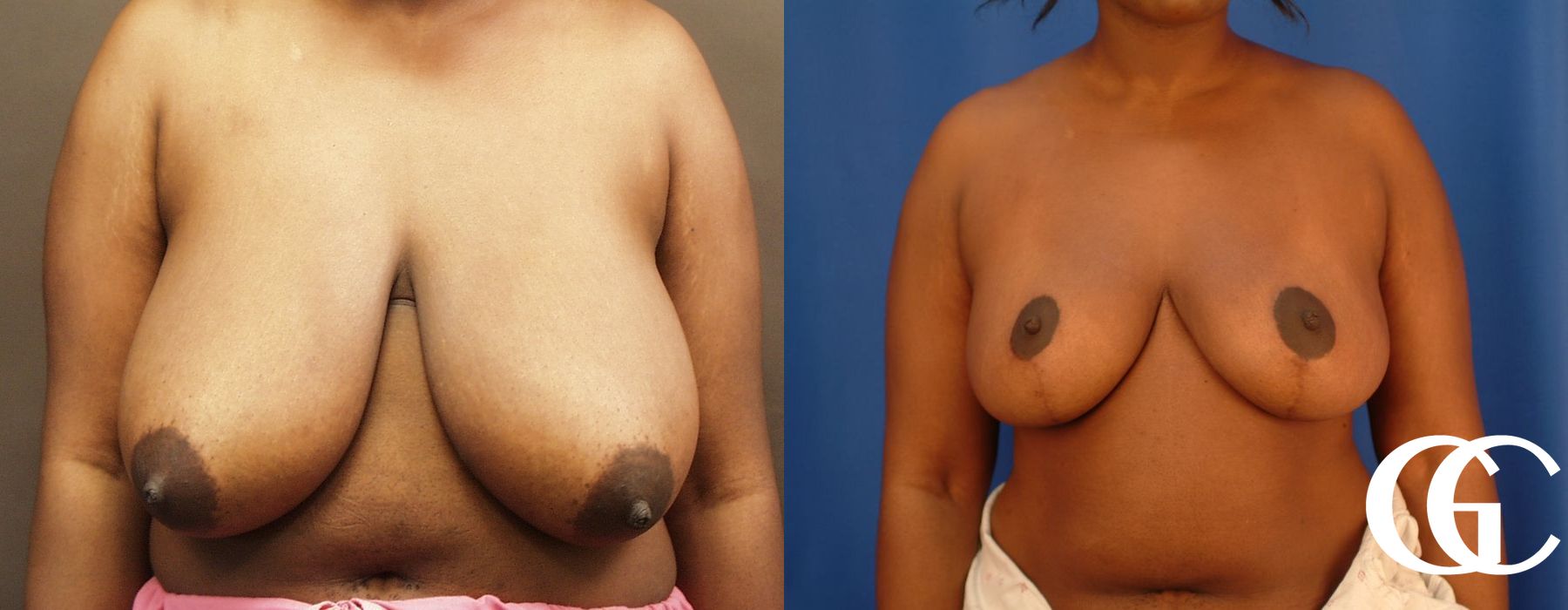 Breast Reduction - Case 7308