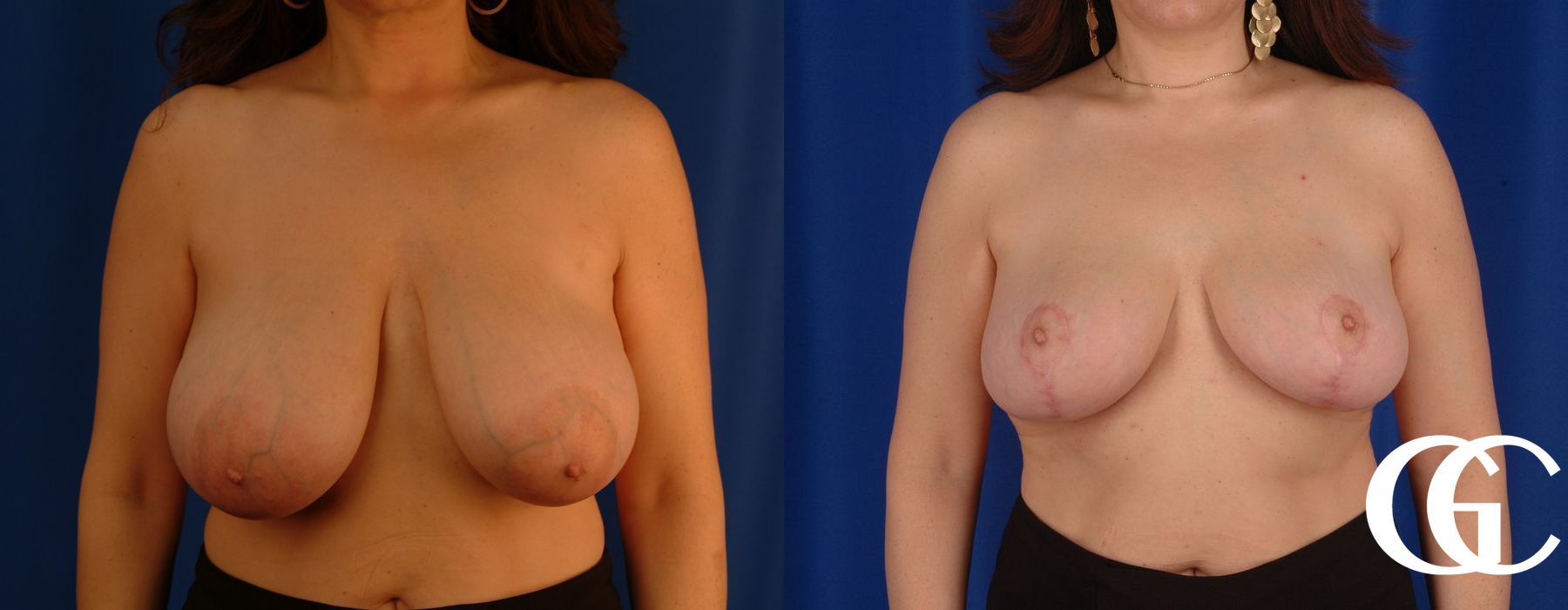 Breast Reduction - Thumbnail 2
