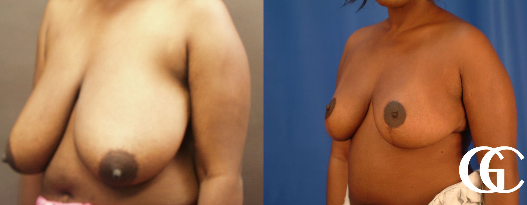 Breast Reduction - Thumbnail 4