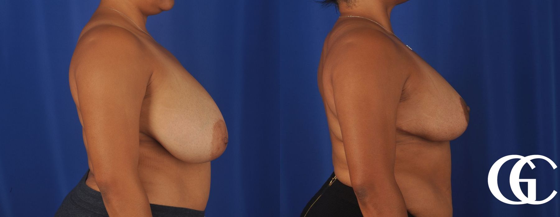 Breast Reduction - Thumbnail 4