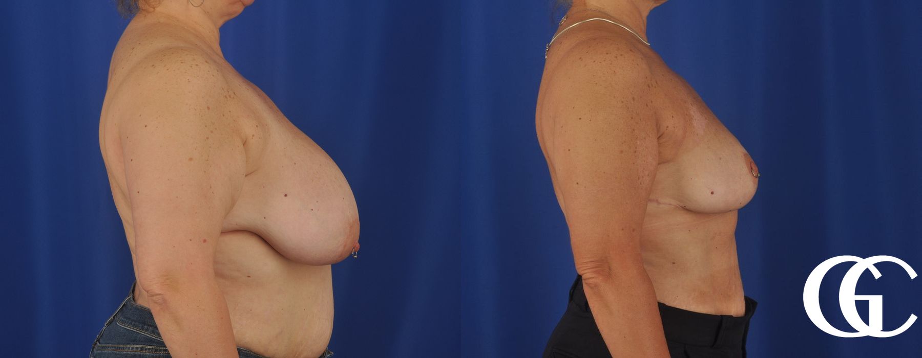 Breast Reduction - Thumbnail 3