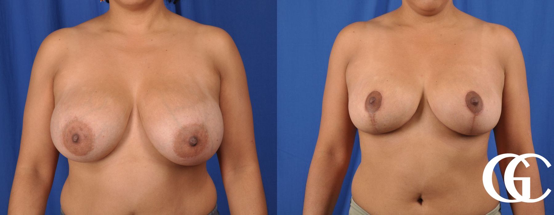 Breast Reduction - Thumbnail 2