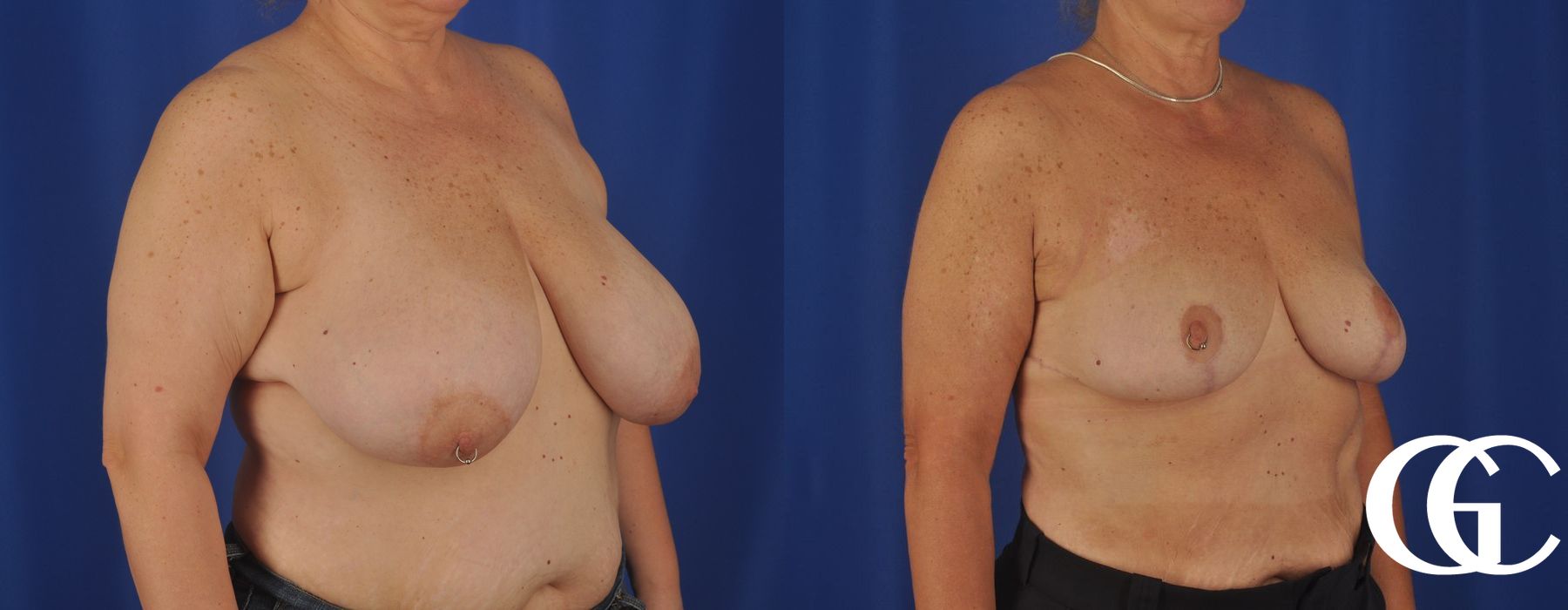 Breast Reduction - Thumbnail 4