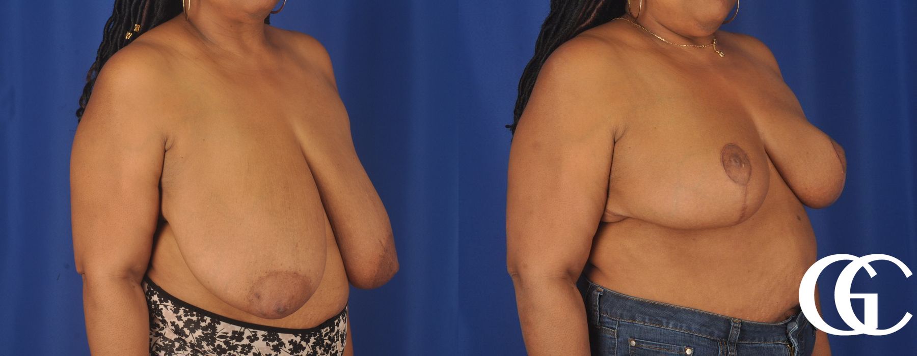 Breast Reduction - Thumbnail 4