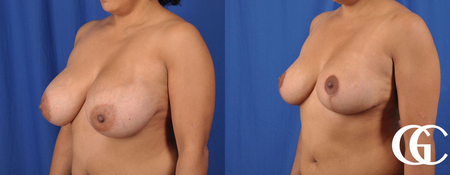 Breast Reduction - Case 7322