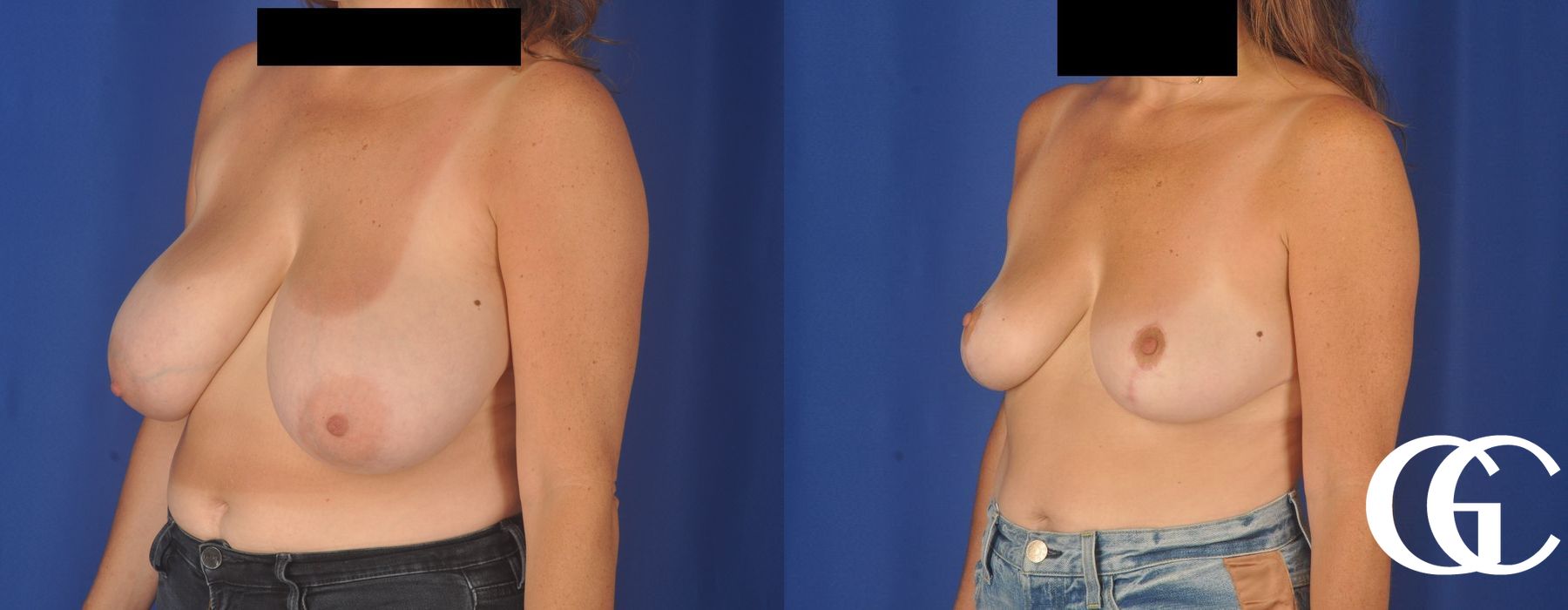 Breast Reduction - Thumbnail 4