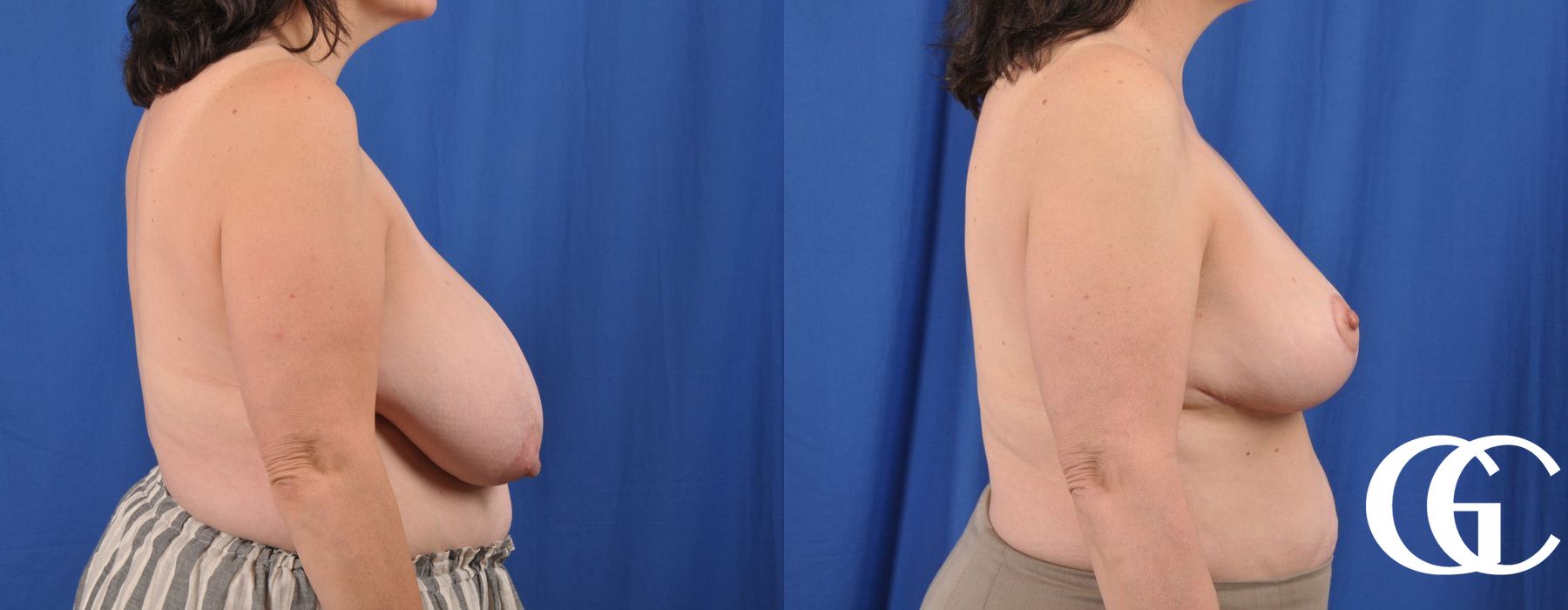 Breast Reduction - Thumbnail 4