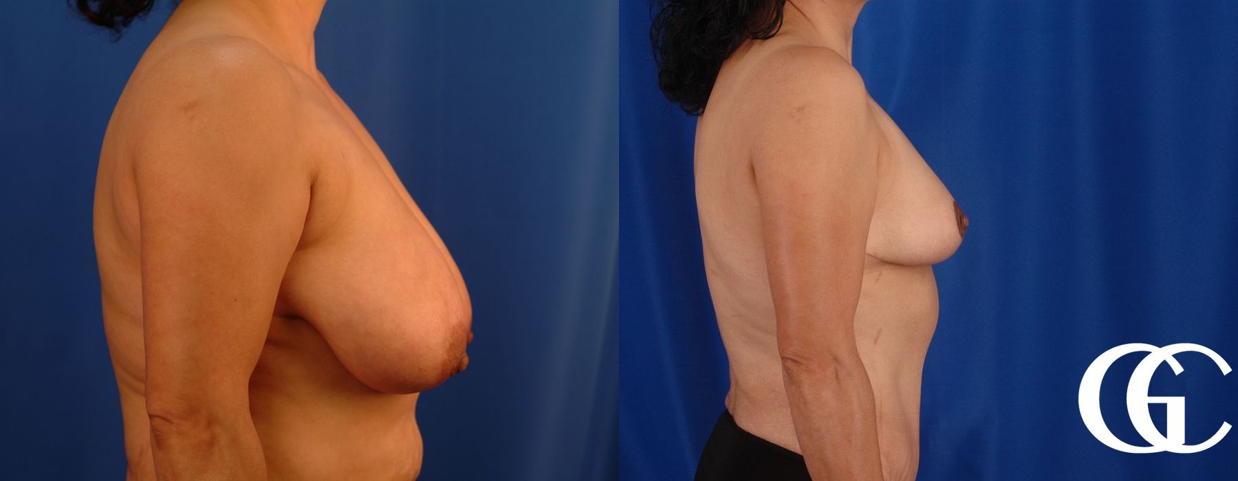 Breast Reduction - Thumbnail 2