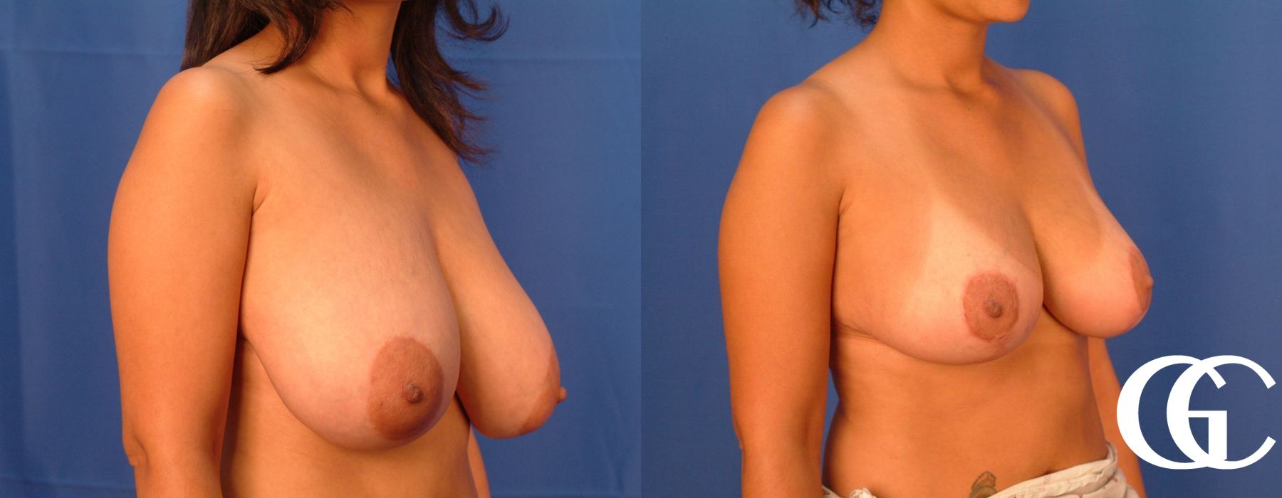 Breast Reduction - Case 7306