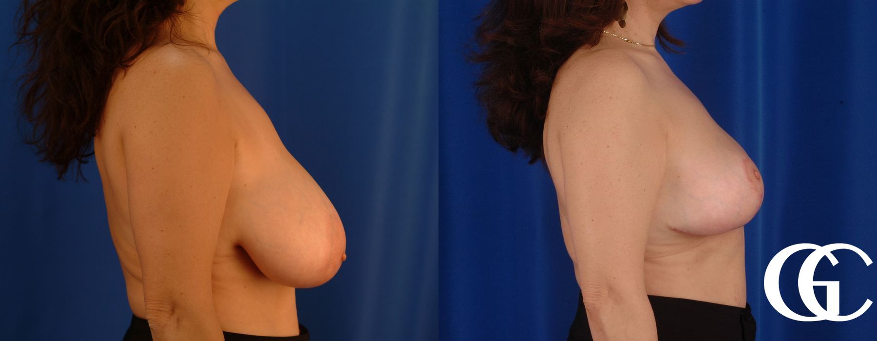 Breast Reduction - Thumbnail 3