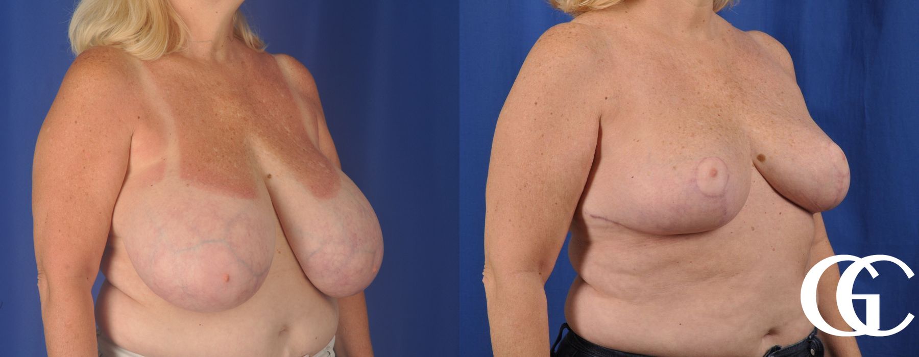 Breast Reduction - Thumbnail 3