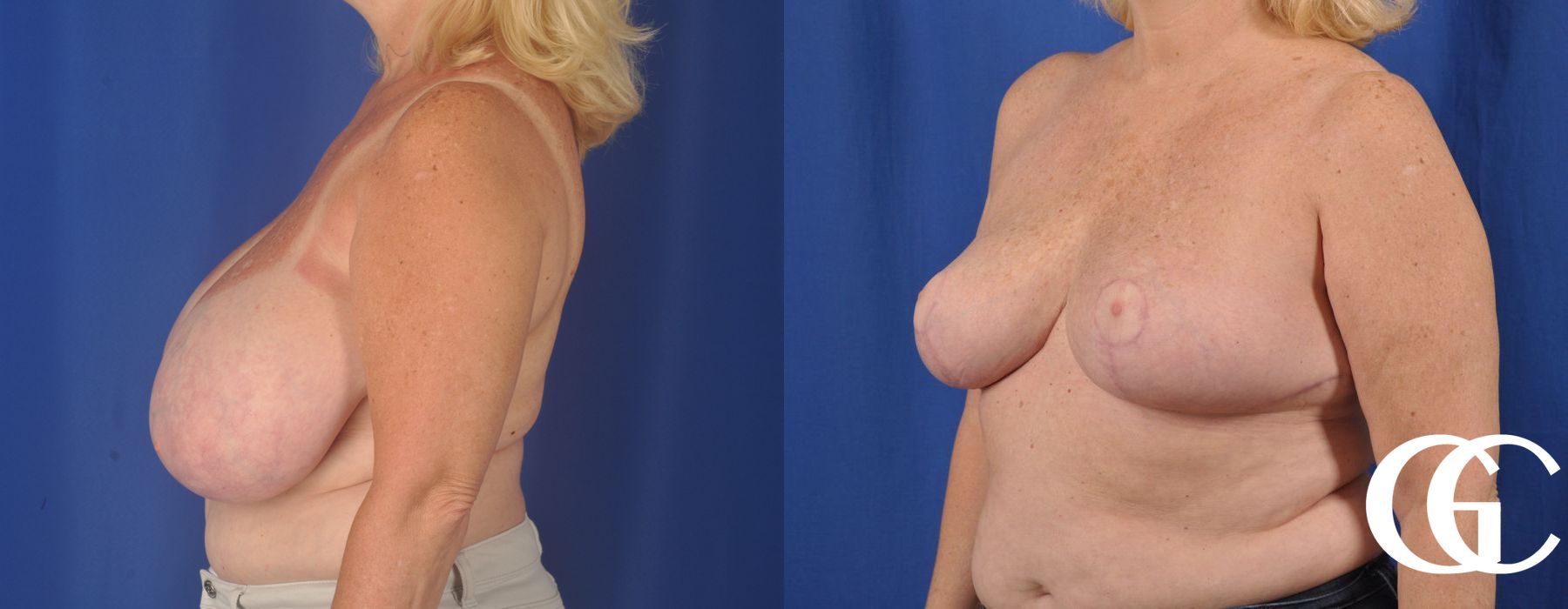Breast Reduction - Case 7327