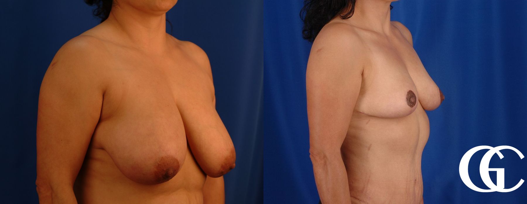 Breast Reduction - Thumbnail 4