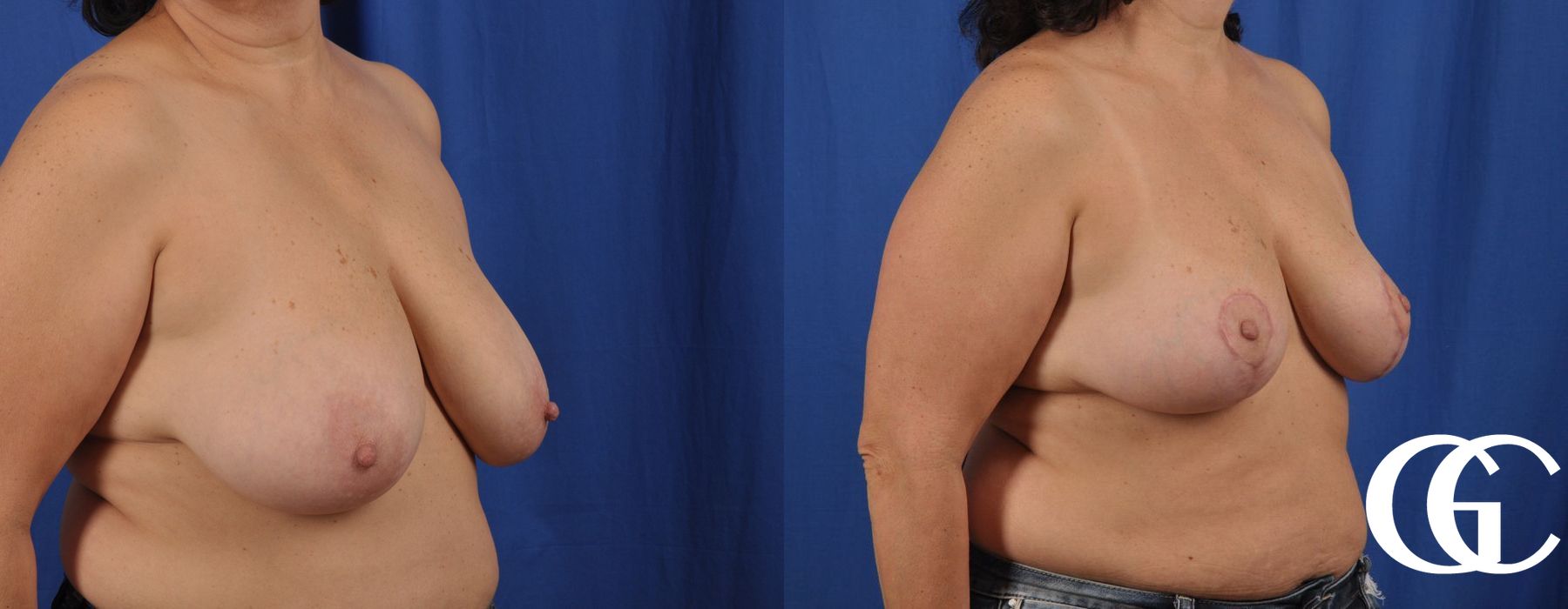 Breast Reduction - Thumbnail 2