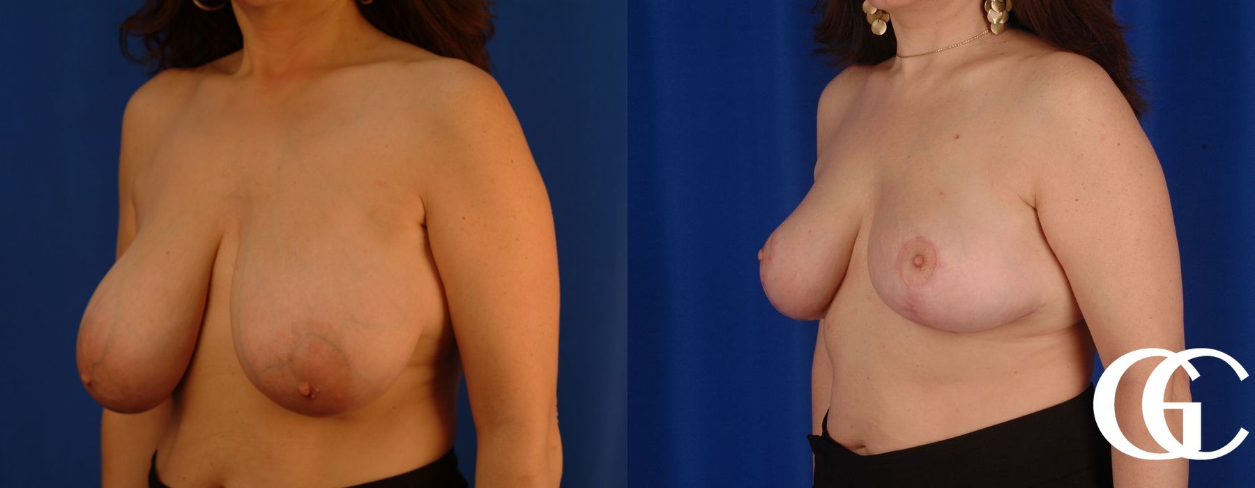 Breast Reduction - Thumbnail 4