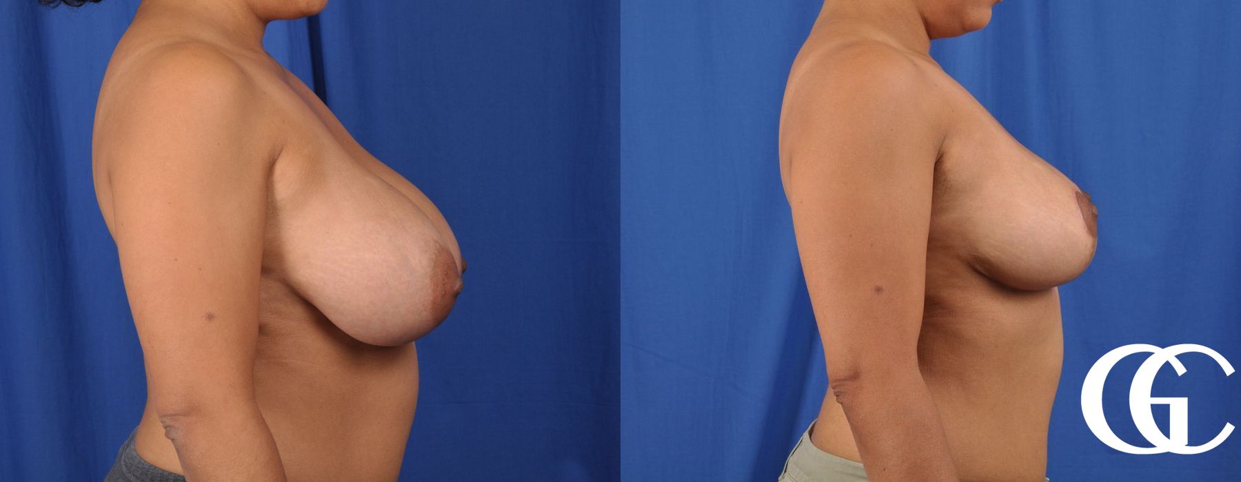 Breast Reduction - Thumbnail 3