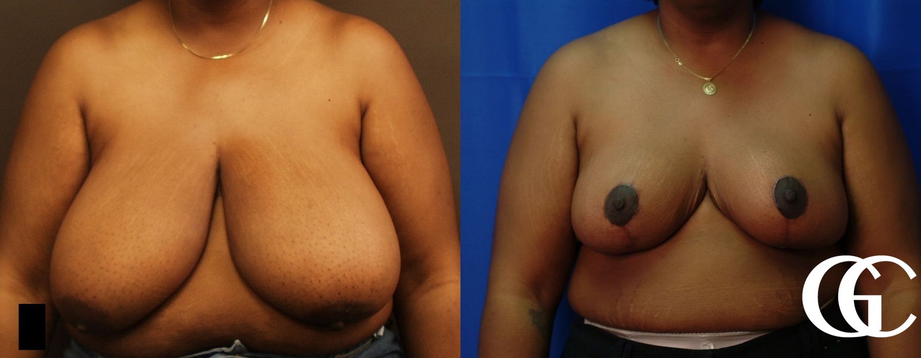 Breast Reduction - Case 7304