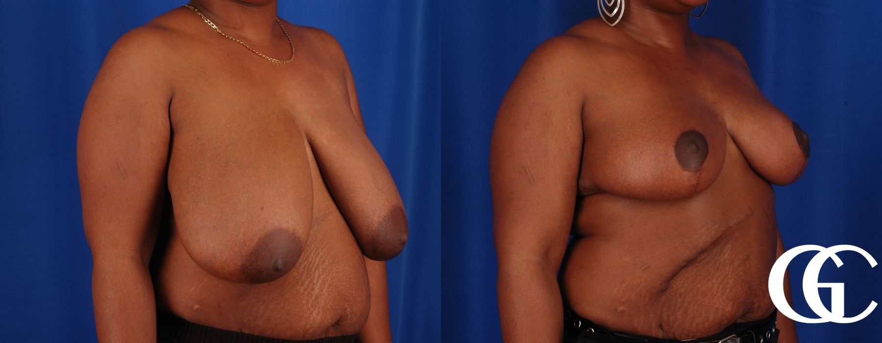 Breast Reduction - Thumbnail 4