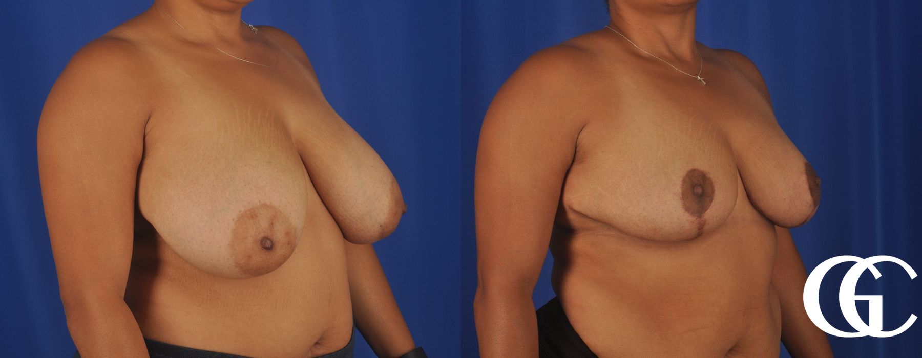 Breast Reduction - Thumbnail 3