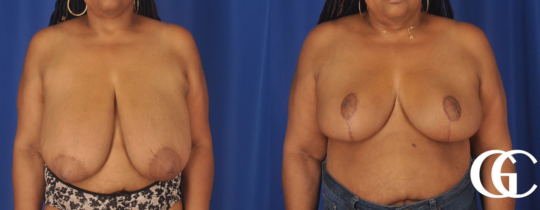 Breast Reduction - Case 7321