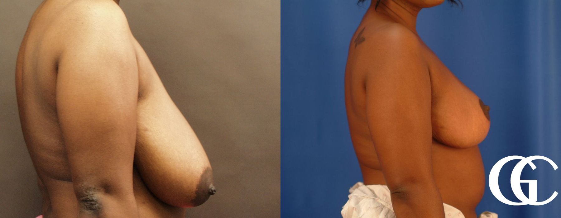 Breast Reduction - Thumbnail 2