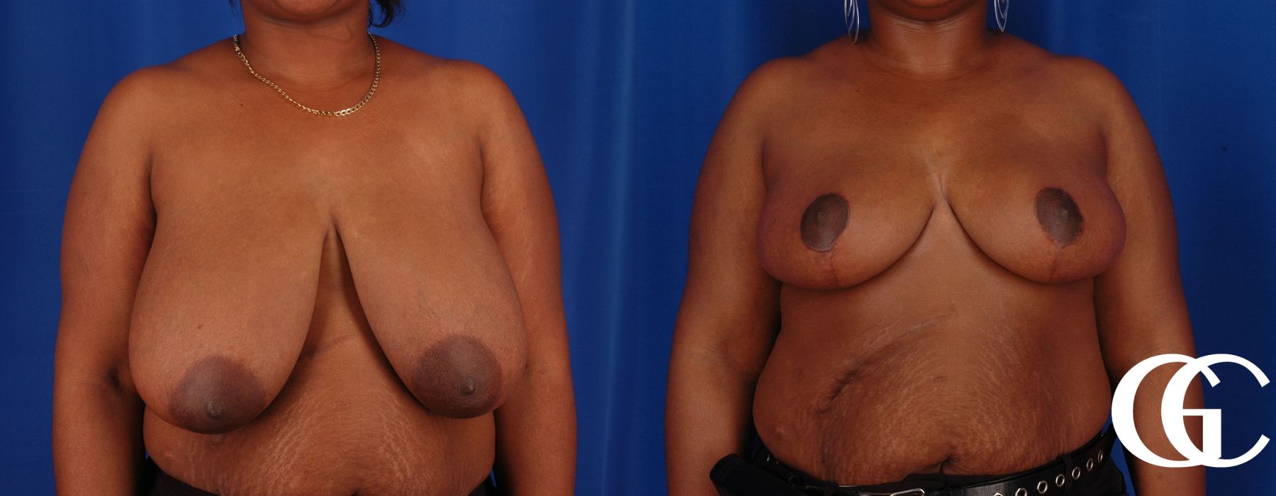Breast Reduction - Thumbnail 2