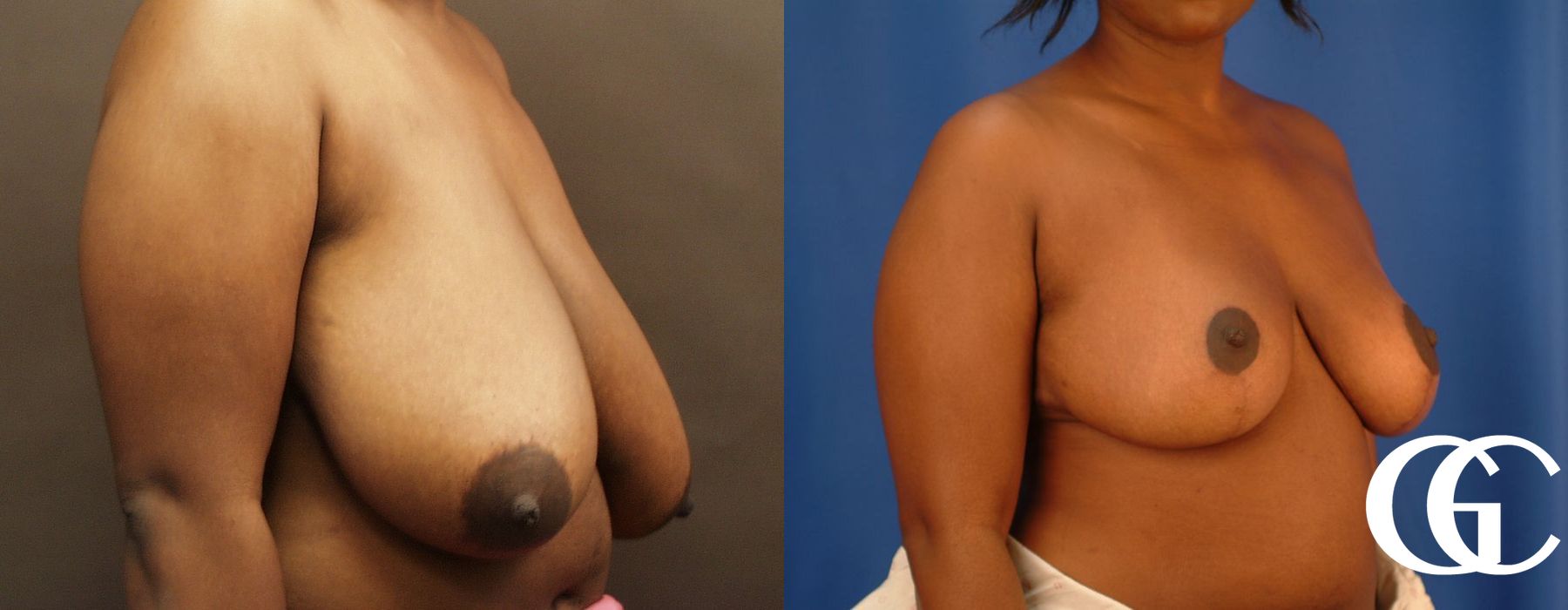 Breast Reduction - Thumbnail 3