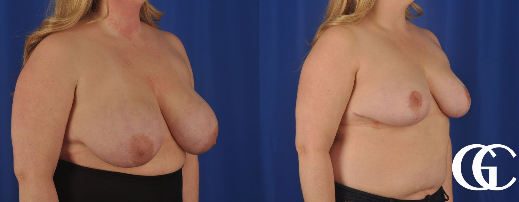 Breast Reduction - Thumbnail 2