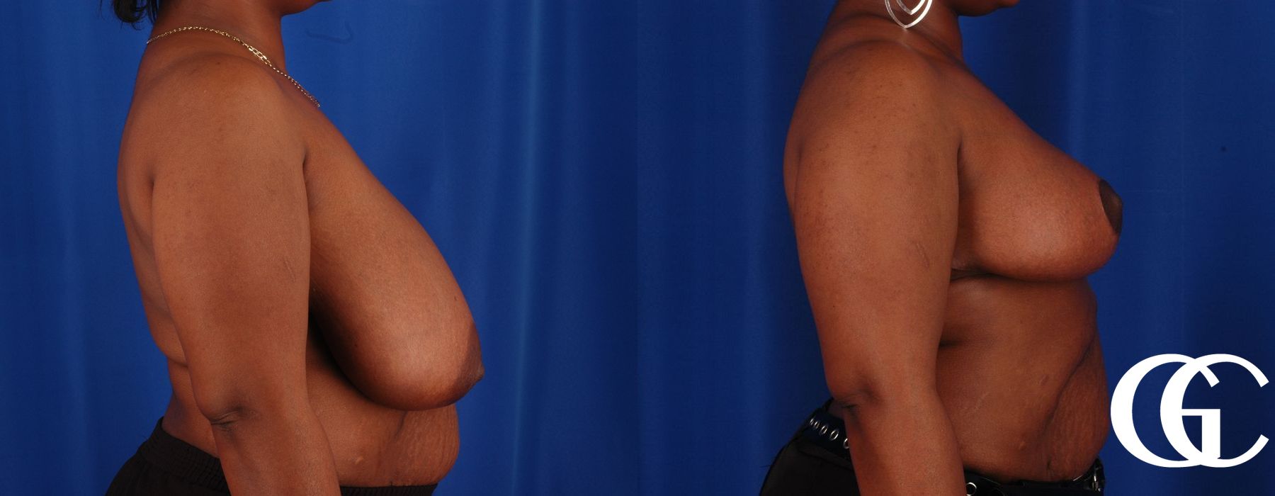 Breast Reduction - Thumbnail 3