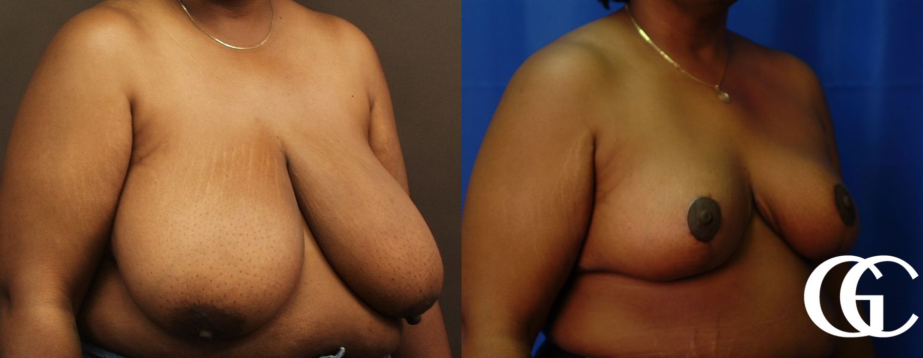 Breast Reduction - Thumbnail 3