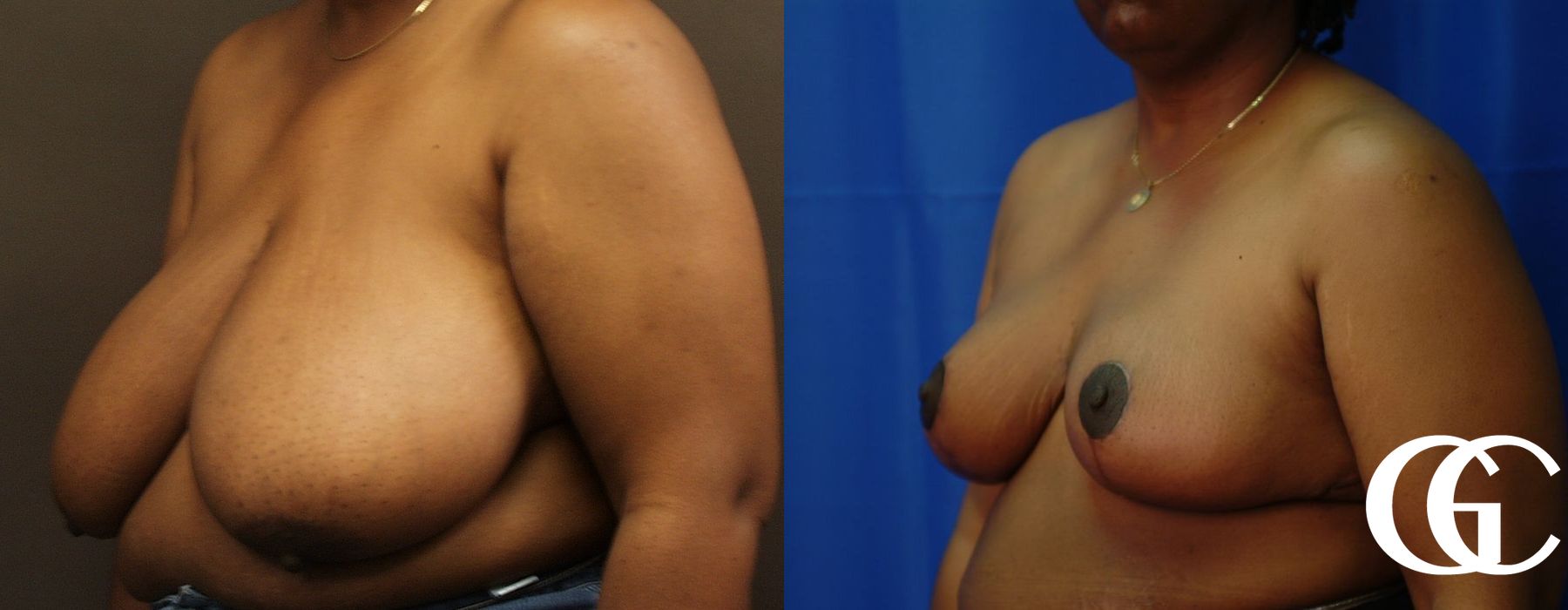 Breast Reduction - Thumbnail 4