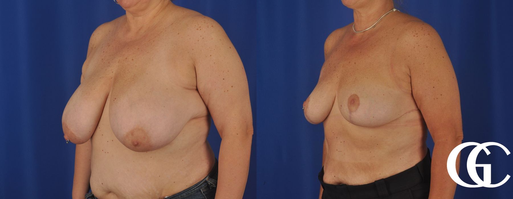 Breast Reduction - Case 7311