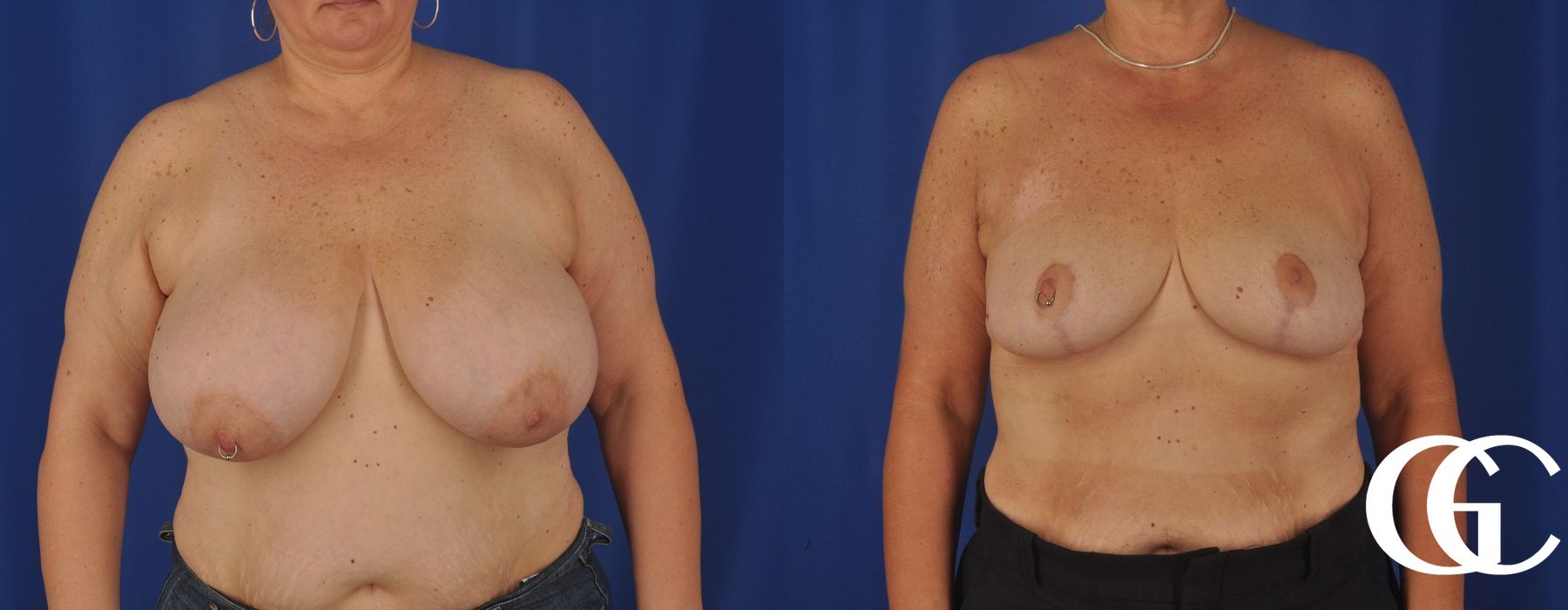 Breast Reduction - Thumbnail 2