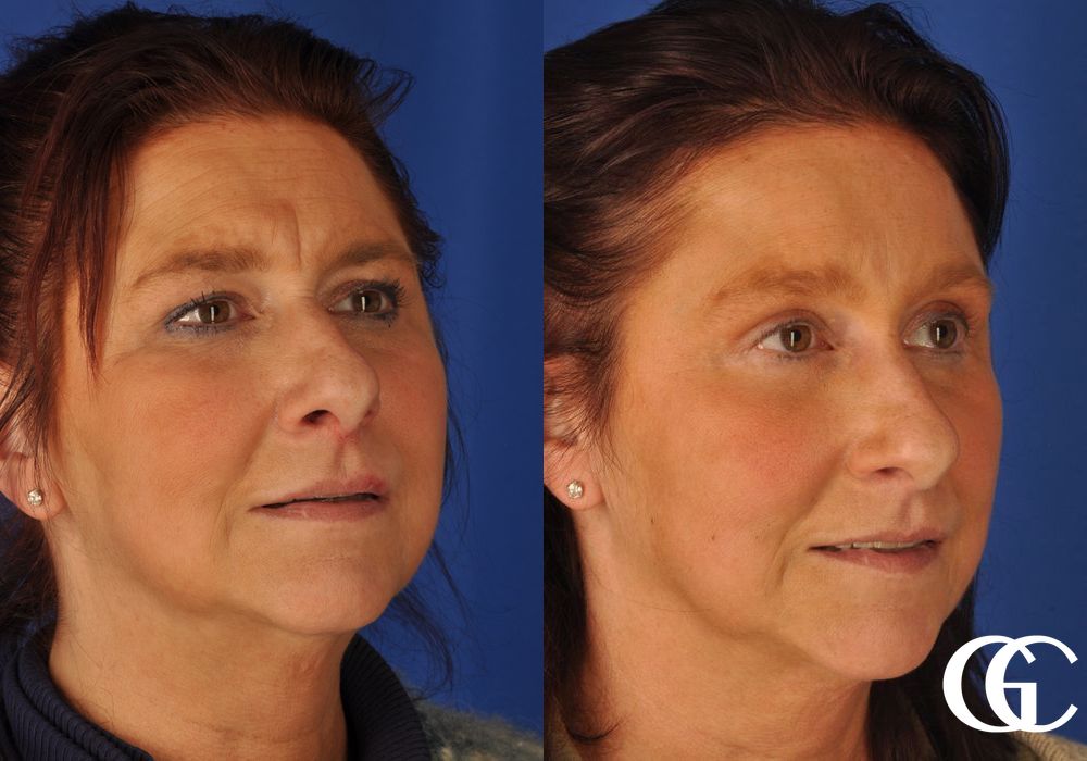 Brow Lift - Thumbnail 4