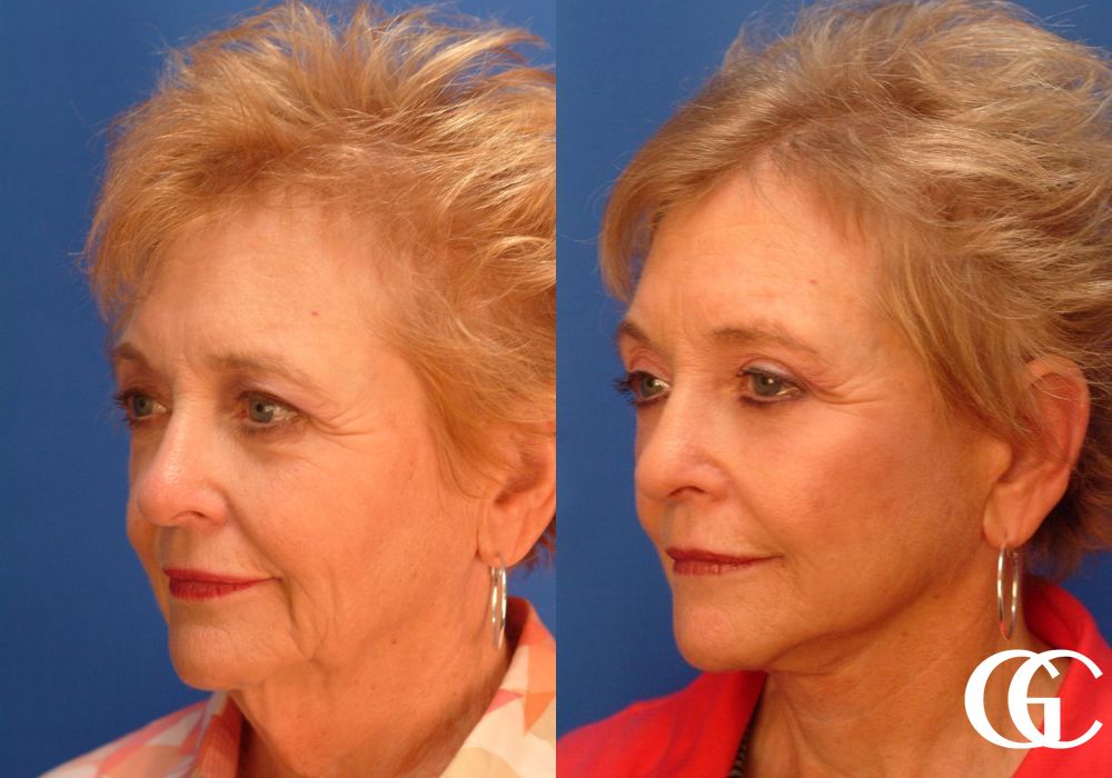 Brow Lift - Thumbnail 2