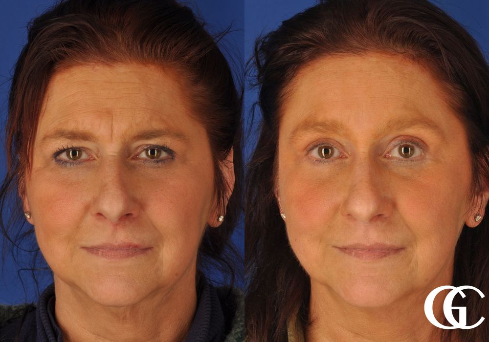 Brow Lift - Thumbnail 2