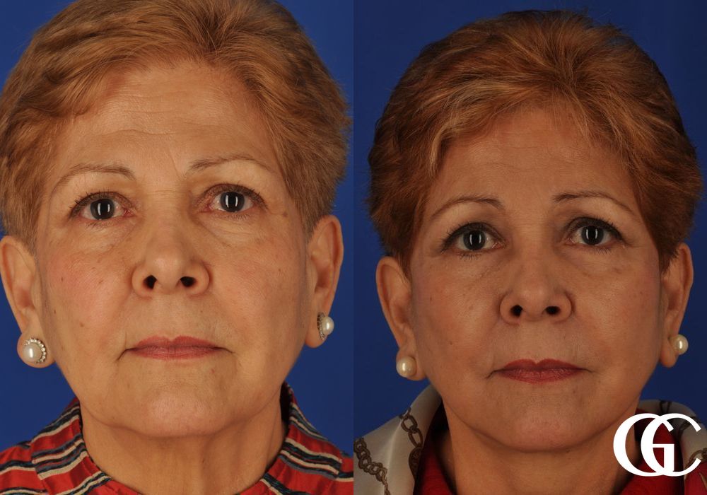 Brow Lift - Thumbnail 2