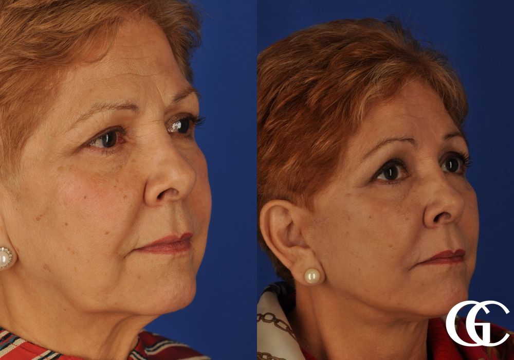 Brow Lift - Thumbnail 3