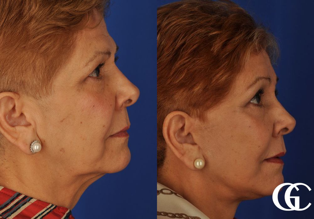 Brow Lift - Case 7389