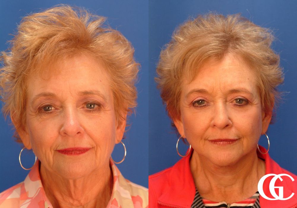 Brow Lift - Case 7391