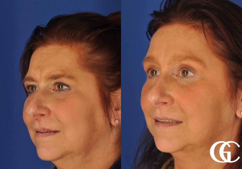 Brow Lift - Case 7393