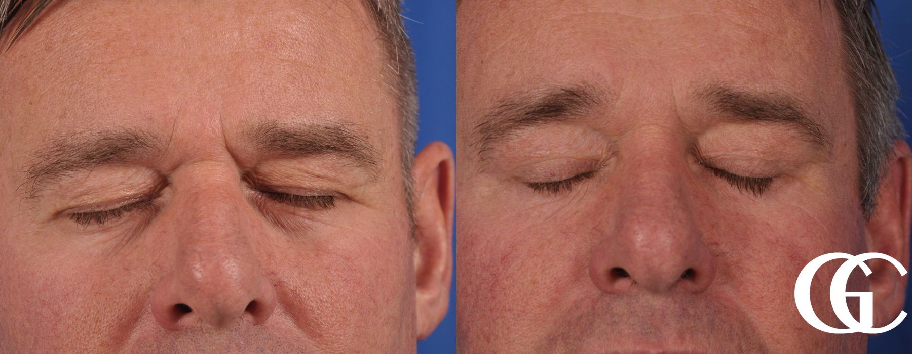 Brow Lift for Men - Thumbnail 2