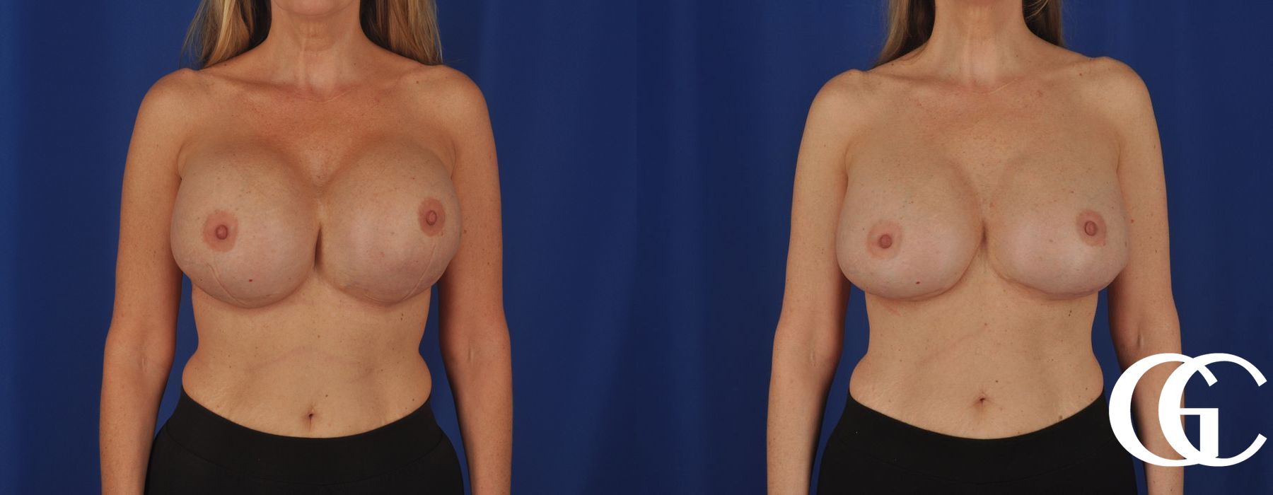 Complex Breast Augmentation - Thumbnail 2