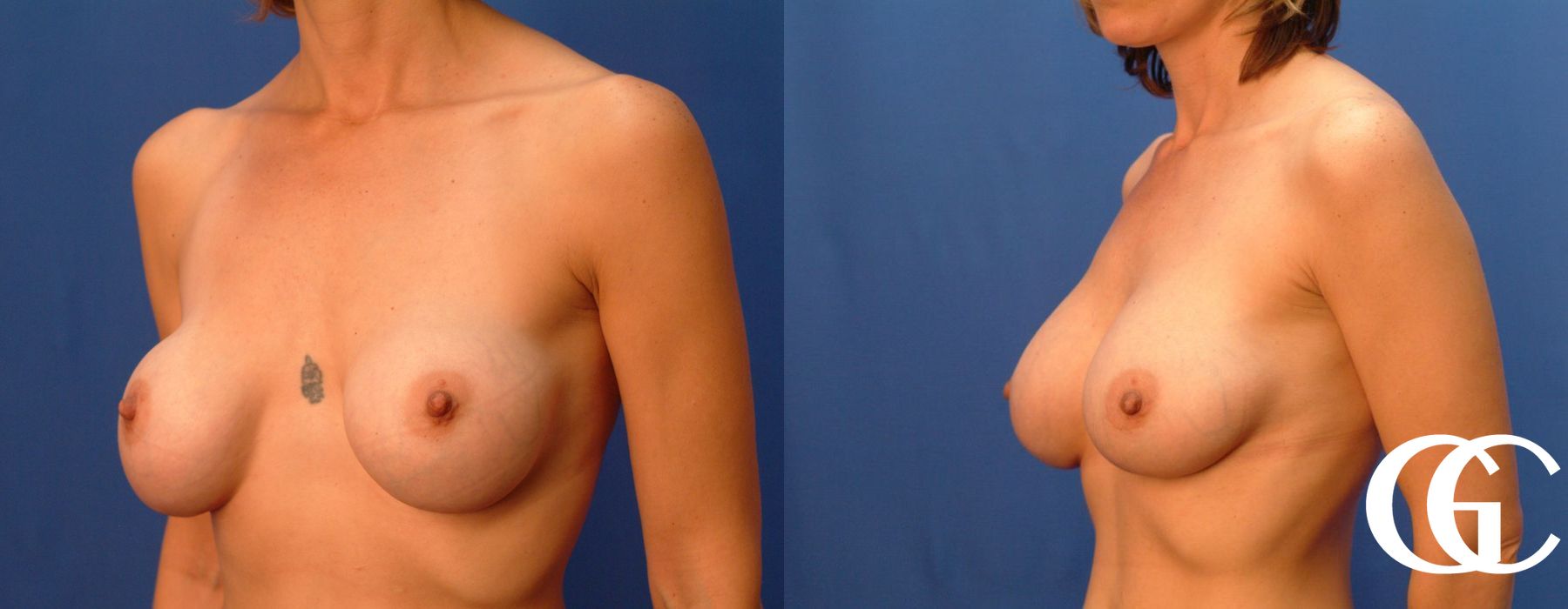 Complex Breast Augmentation - Case 7354