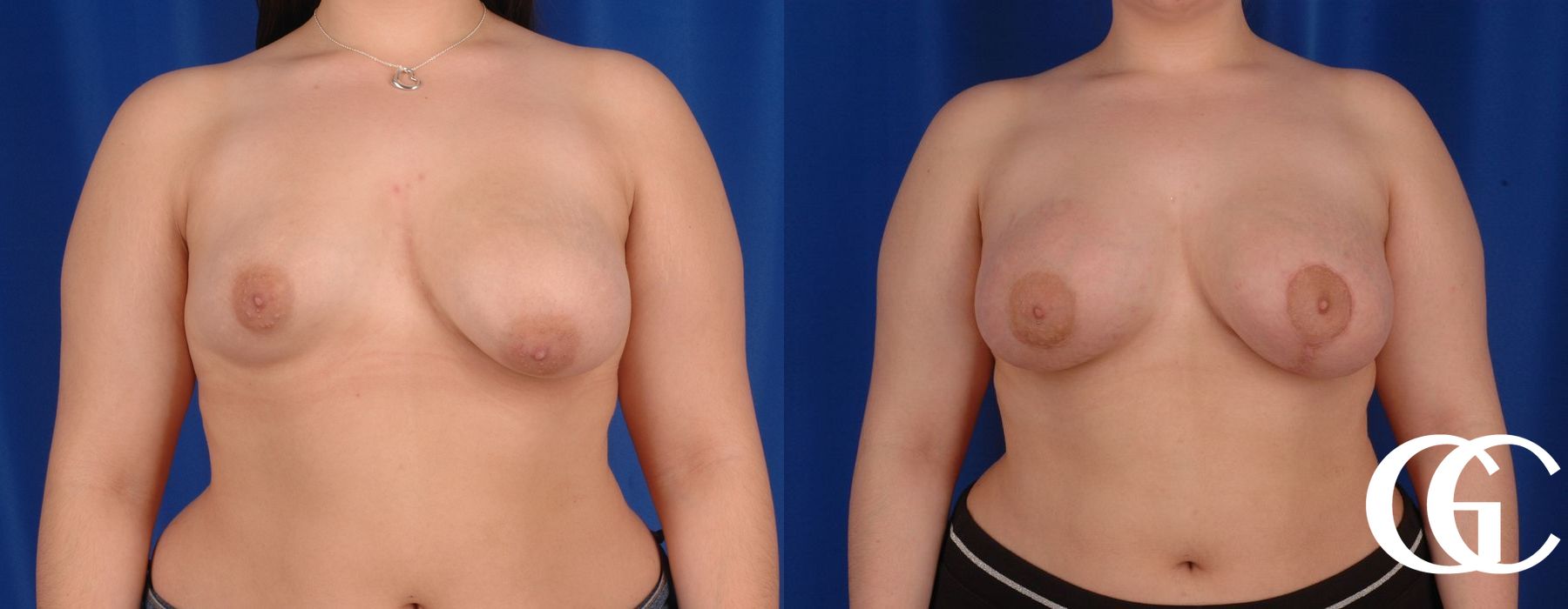 Complex Breast Augmentation - Case 7359