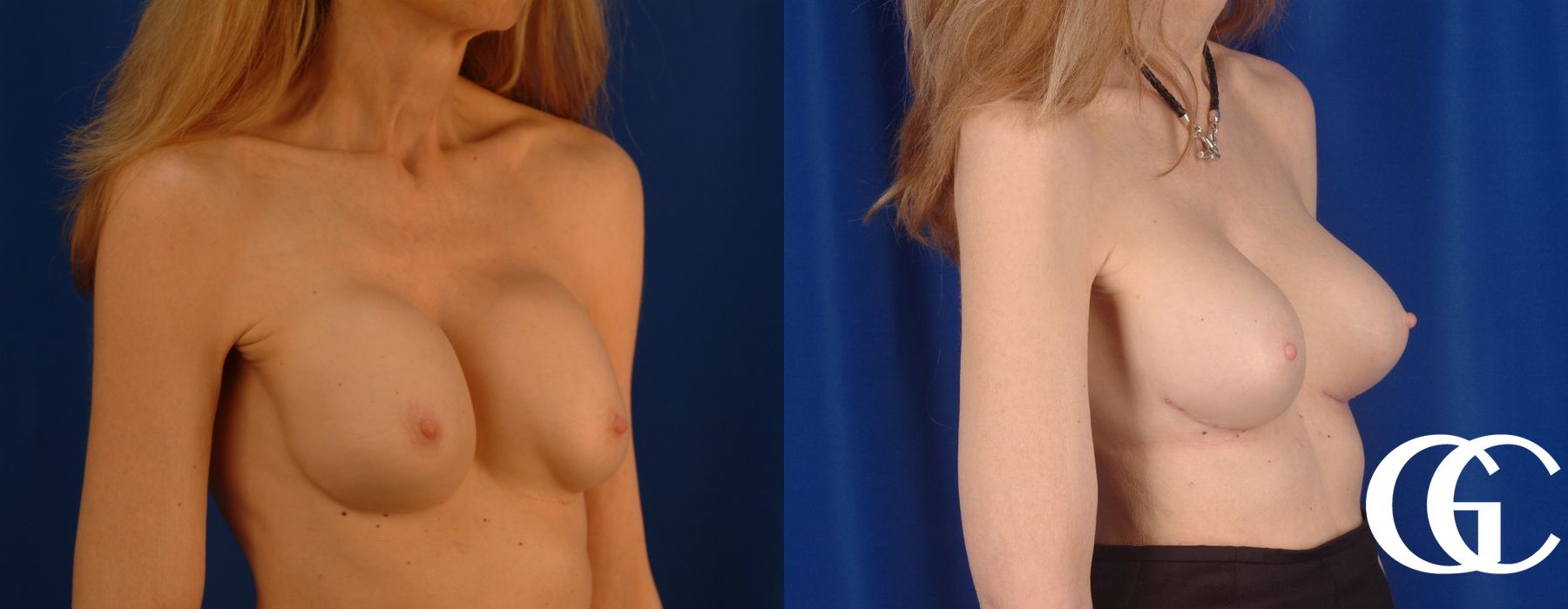 Complex Breast Augmentation - Case 7351
