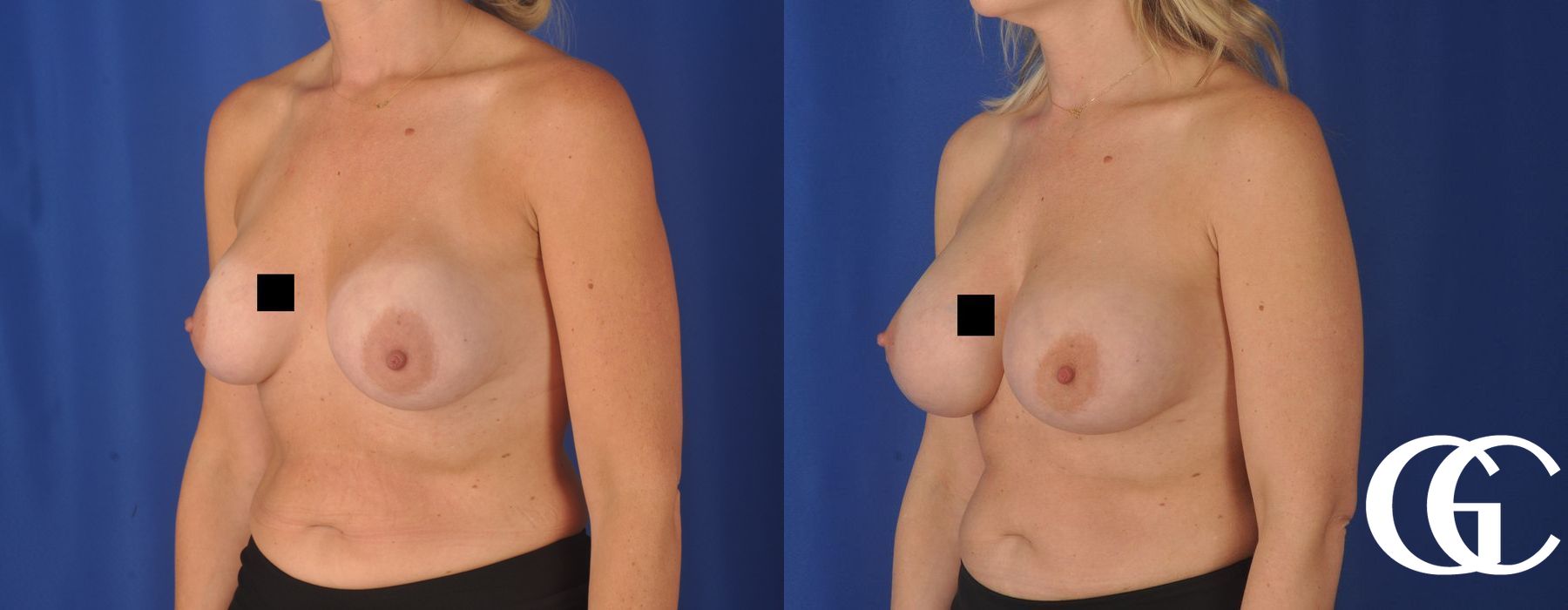 Complex Breast Augmentation - Thumbnail 2